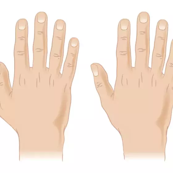 Polydactyly illustration