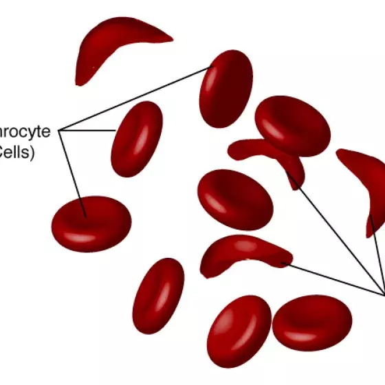 Sickle cell disease illustration